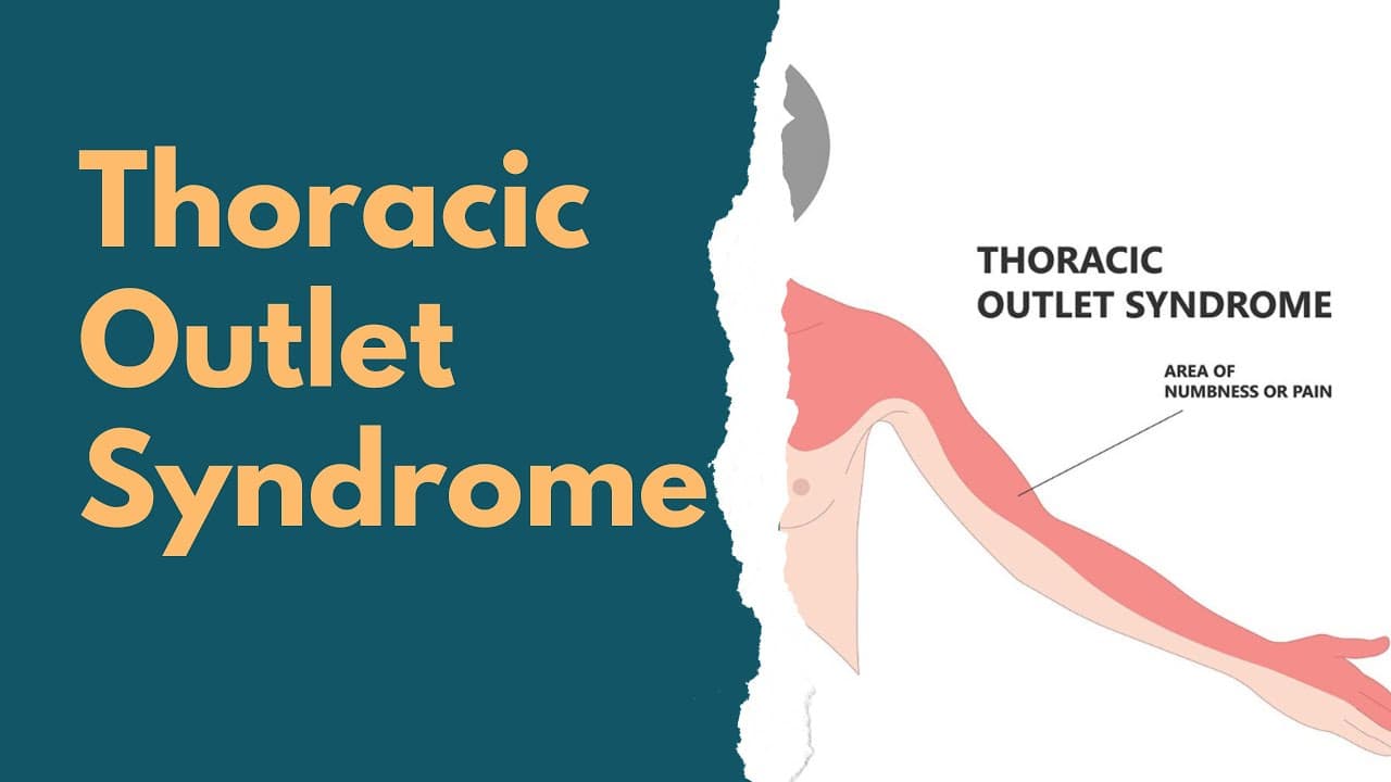 Top 5 Thoracic Outlet Syndrome Exercises for Pain Relief & Nerve Release