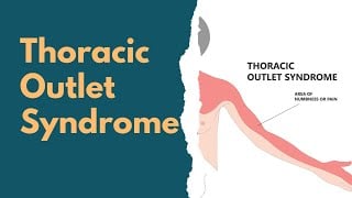Top 5 Thoracic Outlet Syndrome Exercises for Pain Relief & Nerve Release