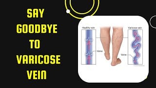 Best Exercises to Improve Circulation & Reduce Varicose Veins